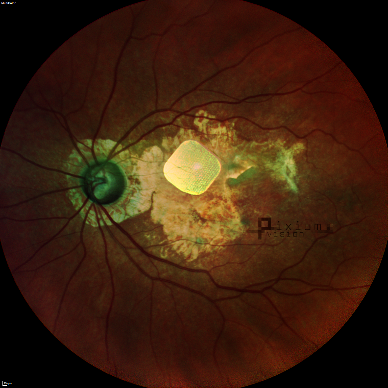 prima-eye-fundus